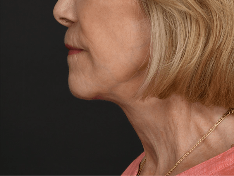 Neck Lift Before & After Gallery - Patient 278408 - Image 10