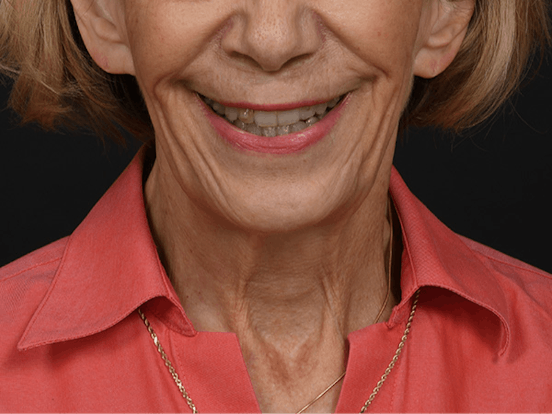 Neck Lift Before & After Gallery - Patient 278408 - Image 11