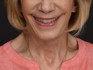Neck Lift Before & After Gallery - Patient 278408 - Image 12