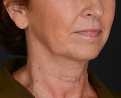 Neck Lift Before & After Gallery - Patient 155407981 - Image 1