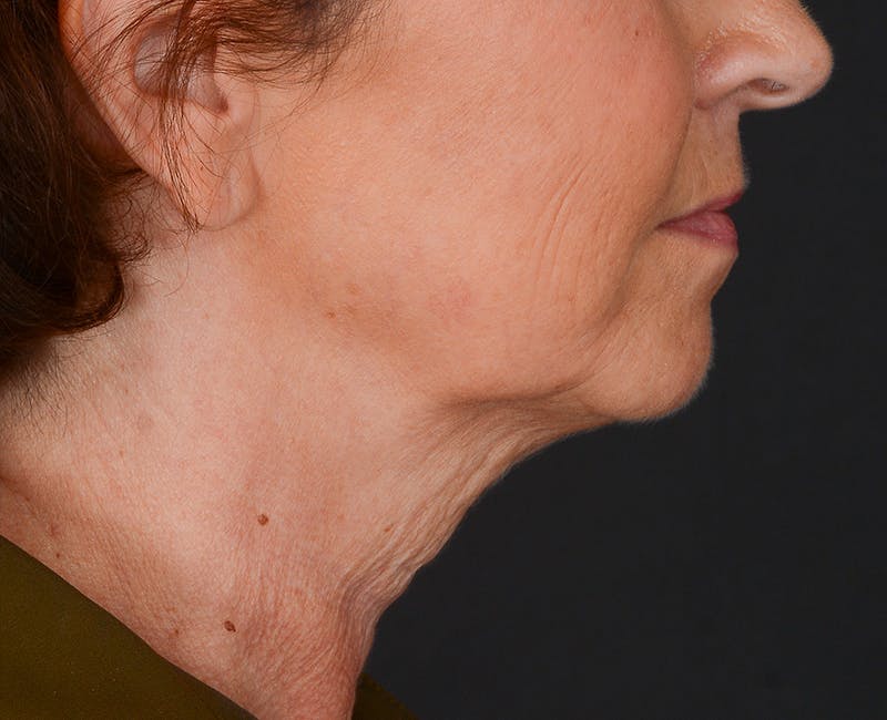 Neck Lift Before & After Gallery - Patient 155407981 - Image 3