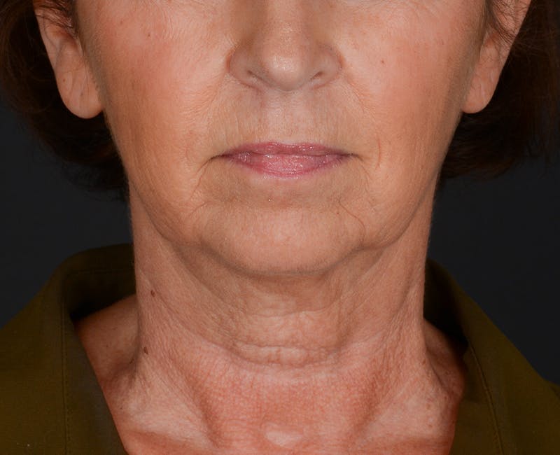 Neck Lift Before & After Gallery - Patient 155407981 - Image 5