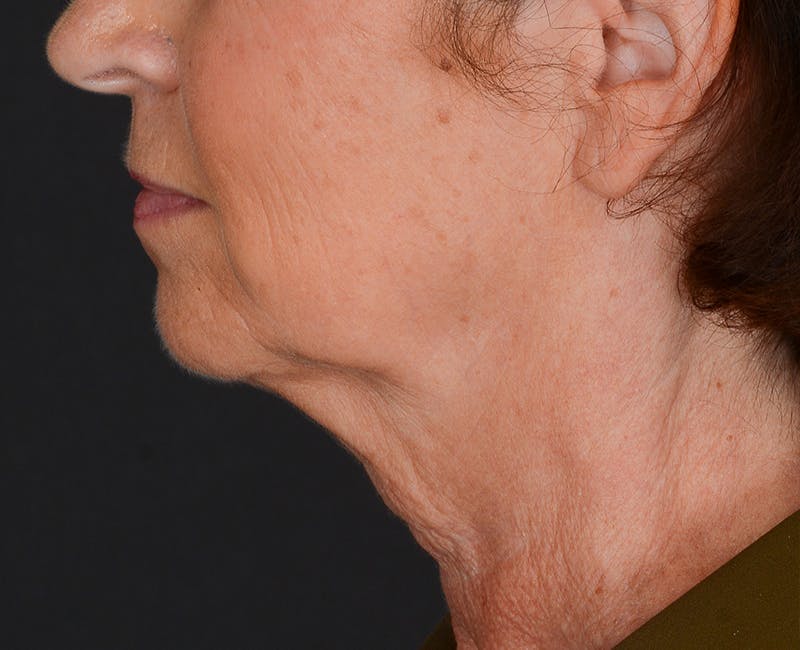 Neck Lift Before & After Gallery - Patient 155407981 - Image 9