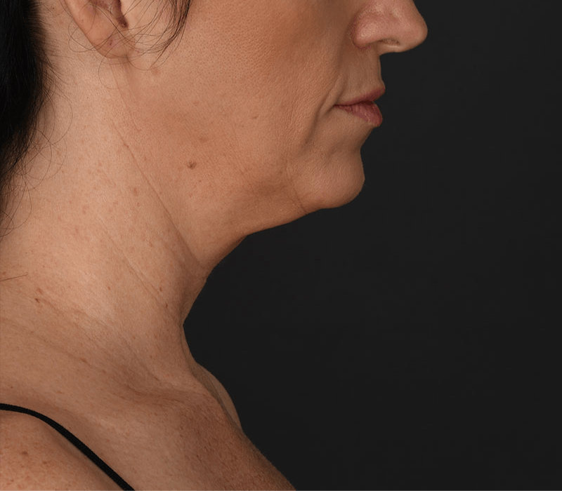 Neck Lift Before & After Gallery - Patient 183321081 - Image 1