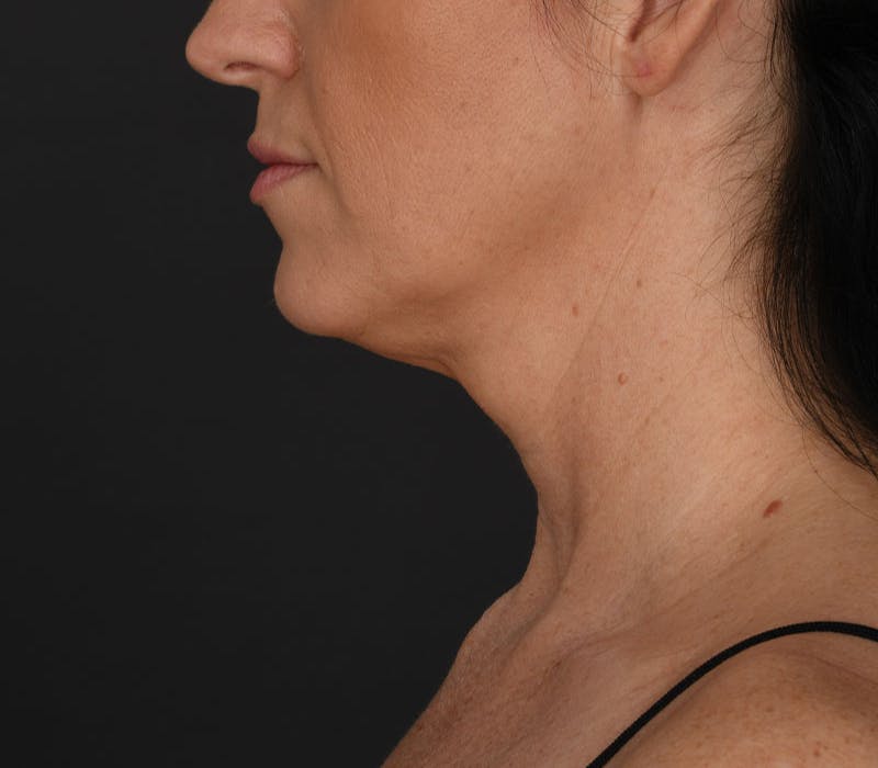 Neck Lift Before & After Gallery - Patient 183321081 - Image 3