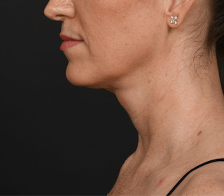 Neck Lift Before & After Gallery - Patient 183321081 - Image 4