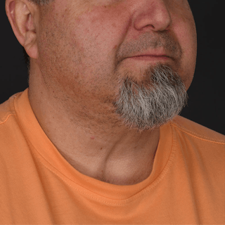 Neck Lift Before & After Gallery - Patient 183321085 - Image 2