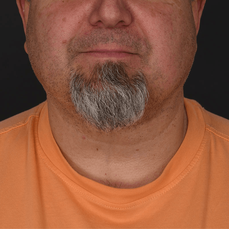 Neck Lift Before & After Gallery - Patient 183321085 - Image 4