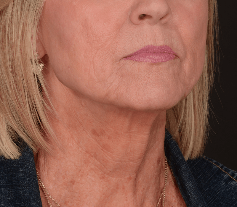 Neck Lift Before & After Gallery - Patient 343591 - Image 1