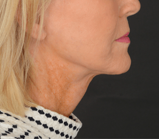 Neck Lift Before & After Gallery - Patient 165625775 - Image 4