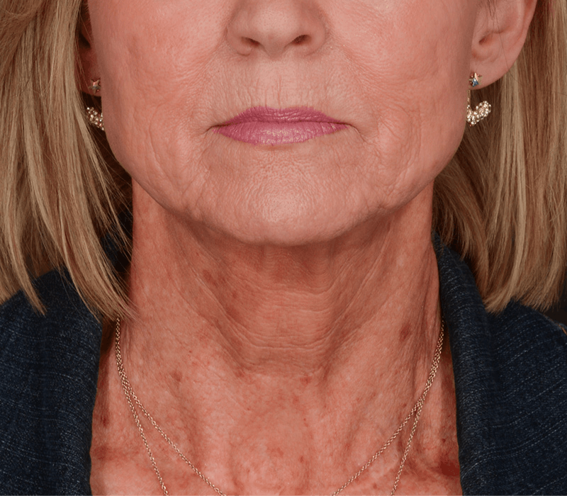 Neck Lift Before & After Gallery - Patient 343591 - Image 5
