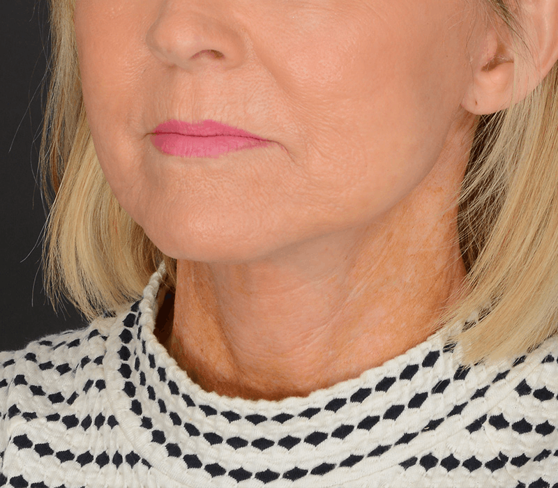 Neck Lift Before & After Gallery - Patient 343591 - Image 10