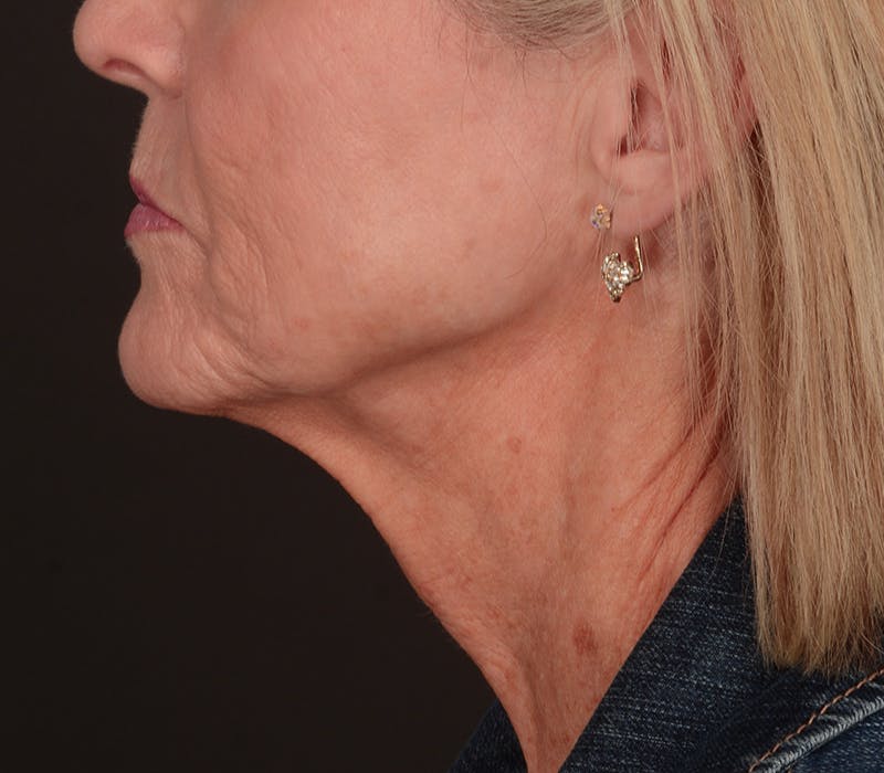 Neck Lift Before & After Gallery - Patient 165625775 - Image 11