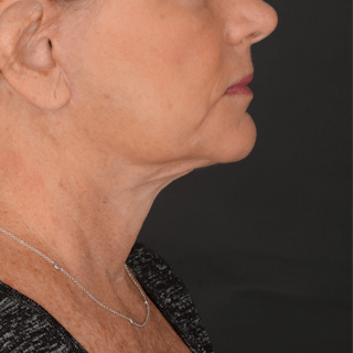 Neck Lift Before & After Gallery - Patient 140123240 - Image 4