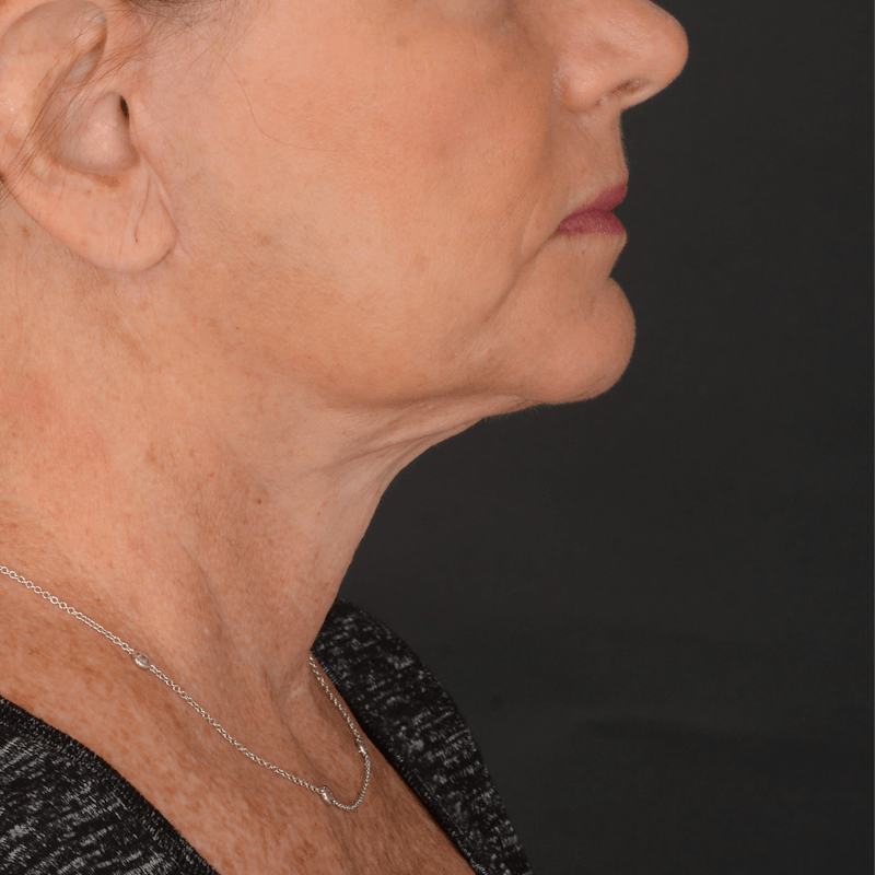 Neck Lift Before & After Gallery - Patient 140123240 - Image 4