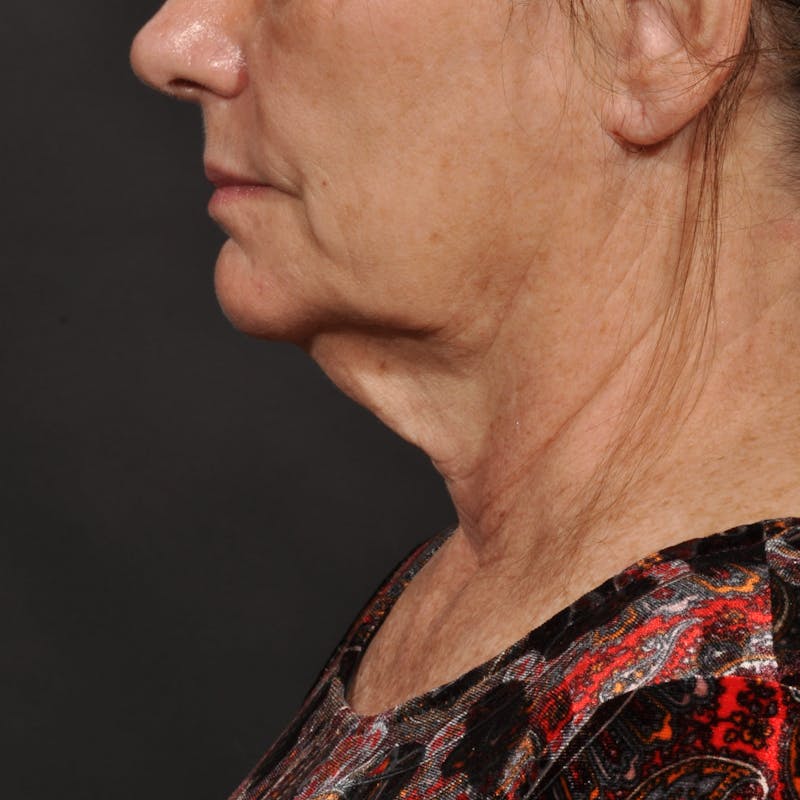 Neck Lift Before & After Gallery - Patient 140123240 - Image 7