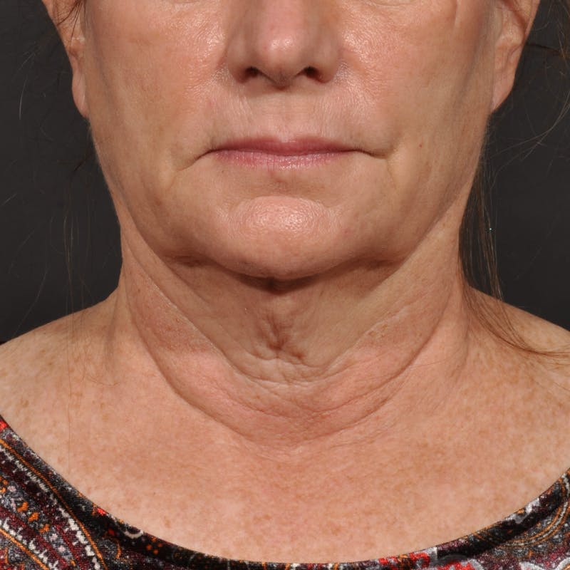 Neck Lift Before & After Gallery - Patient 140123240 - Image 9