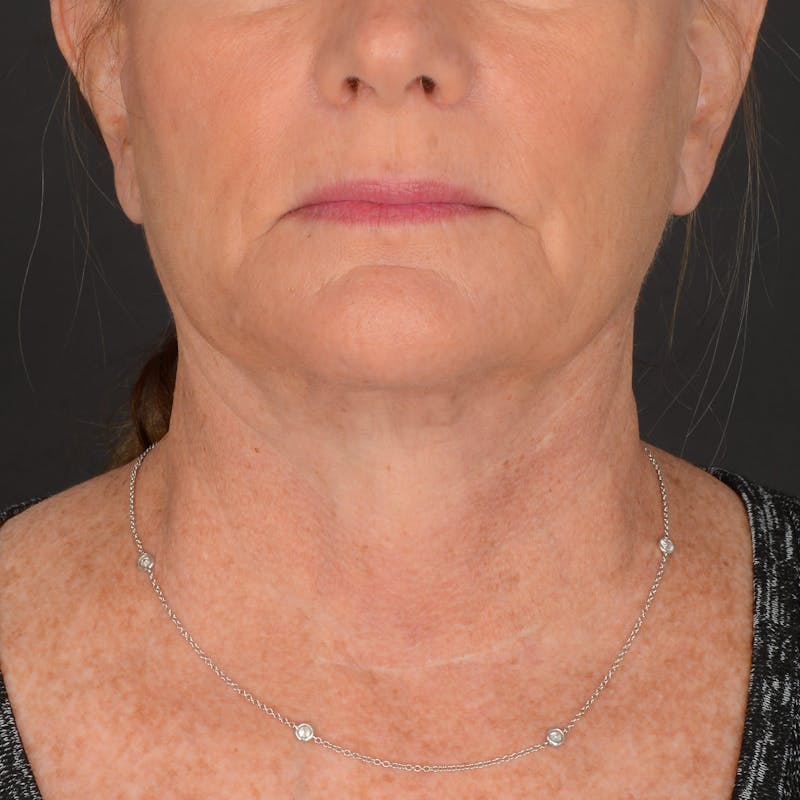 Neck Lift Before & After Gallery - Patient 140123240 - Image 10