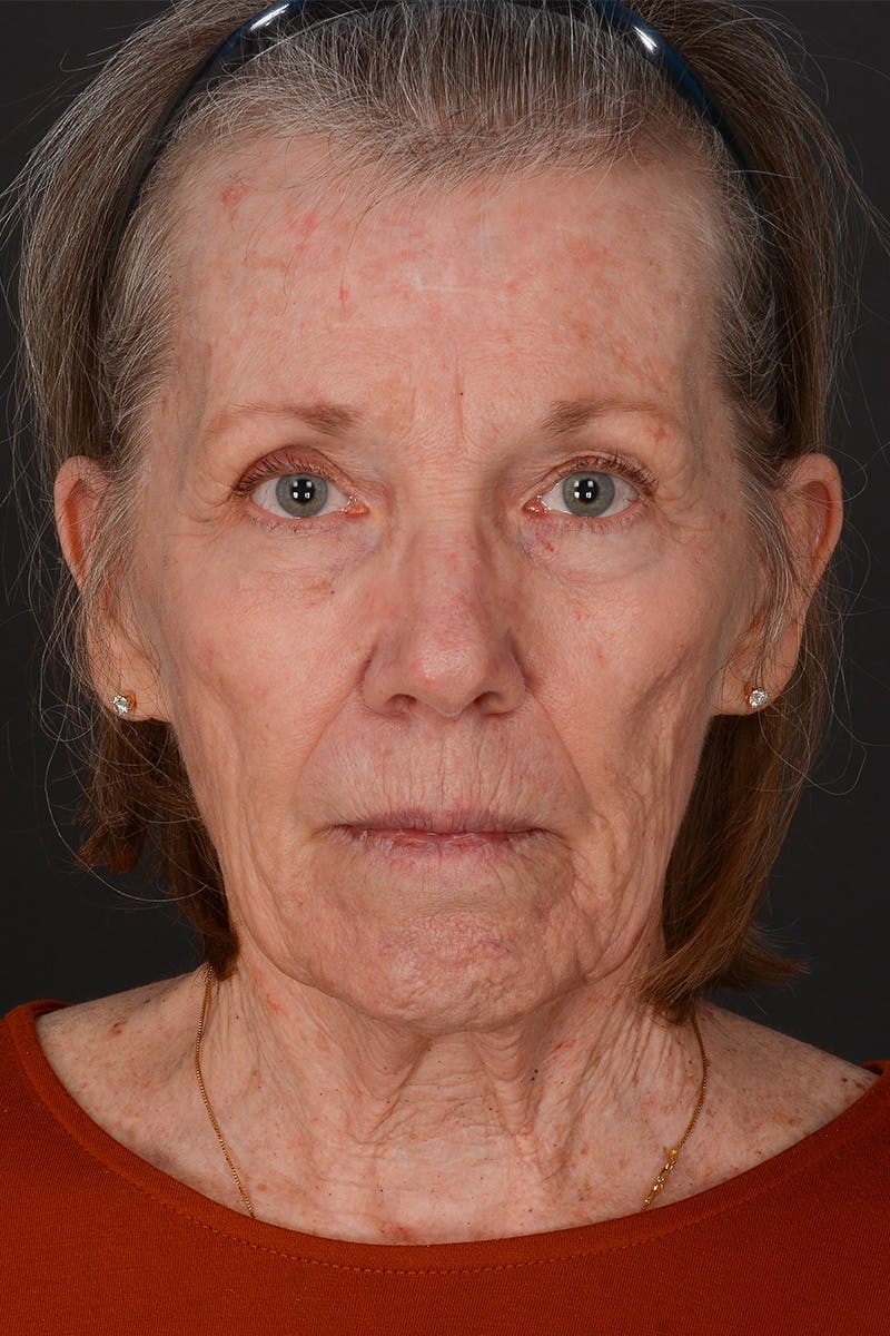 Brow Lift Before & After Gallery - Patient 182478 - Image 1