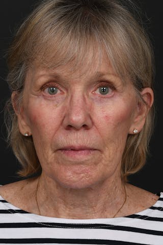 Facelift Before & After Gallery - Patient 149518 - Image 2