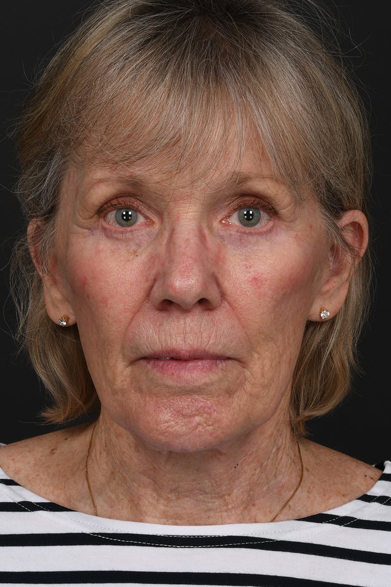 Brow Lift Before & After Gallery - Patient 182478 - Image 2