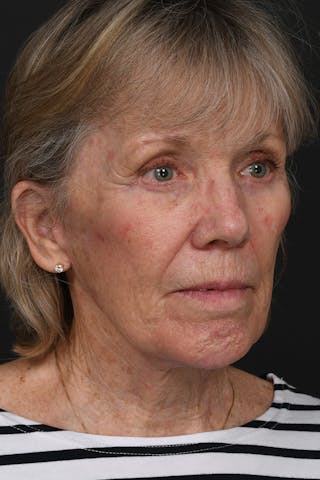 Facelift Before & After Gallery - Patient 149518 - Image 6