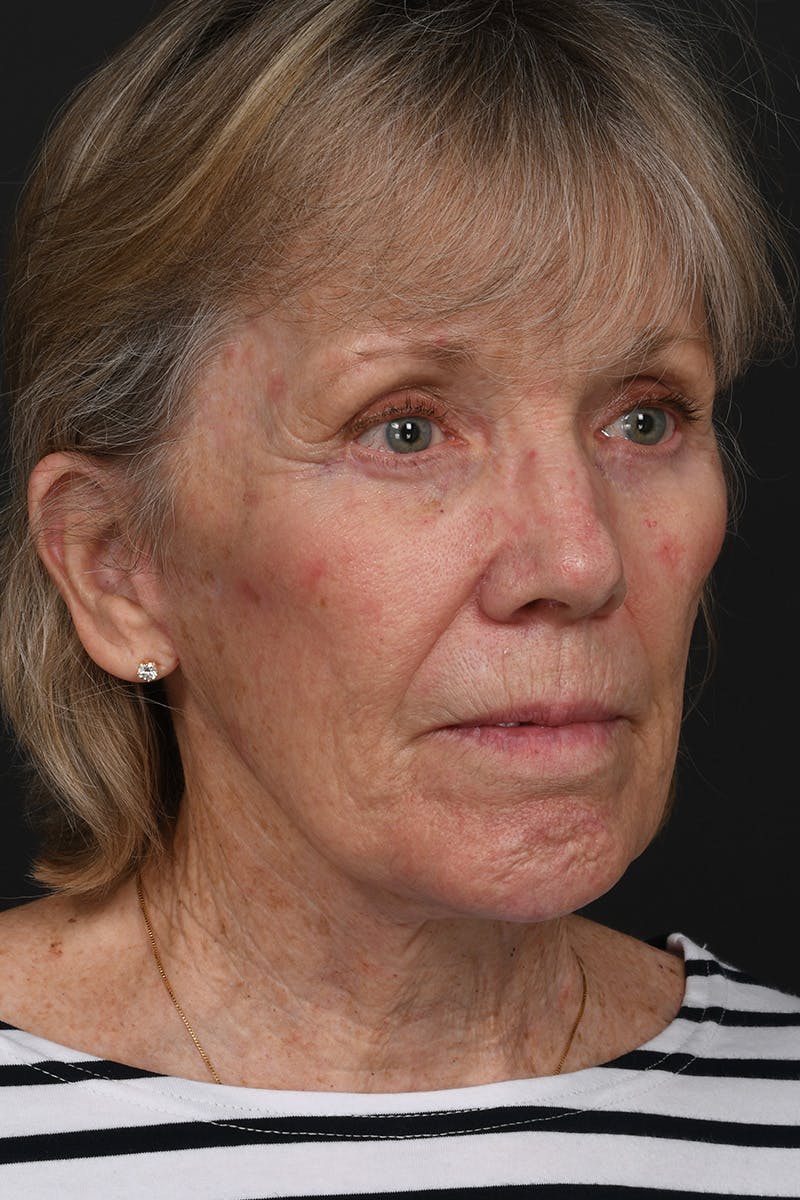 Facelift Before & After Gallery - Patient 149518 - Image 6