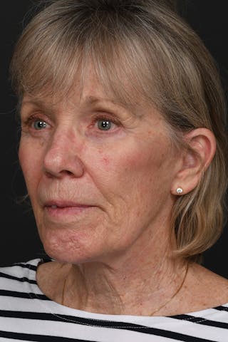 Facelift Before & After Gallery - Patient 149518 - Image 8