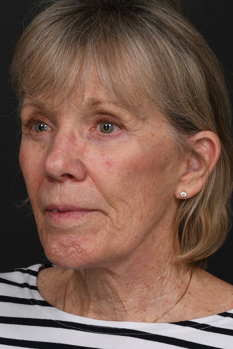 Facelift Before & After Gallery - Patient 149518 - Image 8