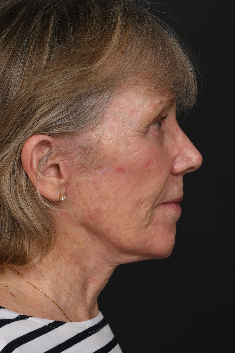 Facelift Before & After Gallery - Patient 149518 - Image 10