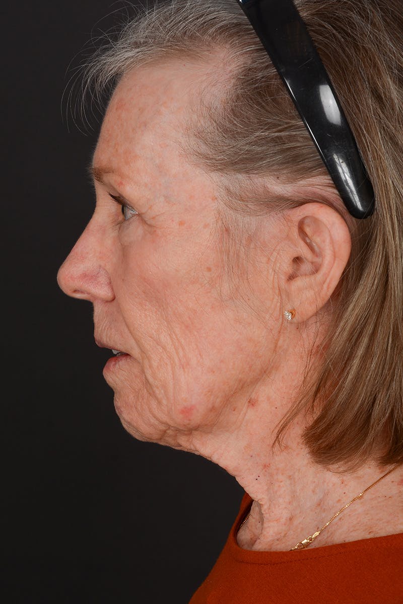 Facelift Before & After Gallery - Patient 149518 - Image 11