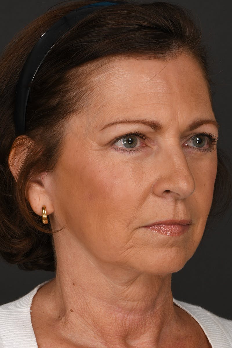 Facelift Before & After Gallery - Patient 155407982 - Image 4