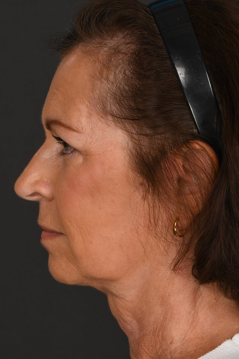 Facelift Before & After Gallery - Patient 155407982 - Image 10