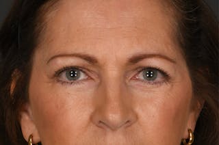 Blepharoplasty Before & After Gallery - Patient 155407963 - Image 2