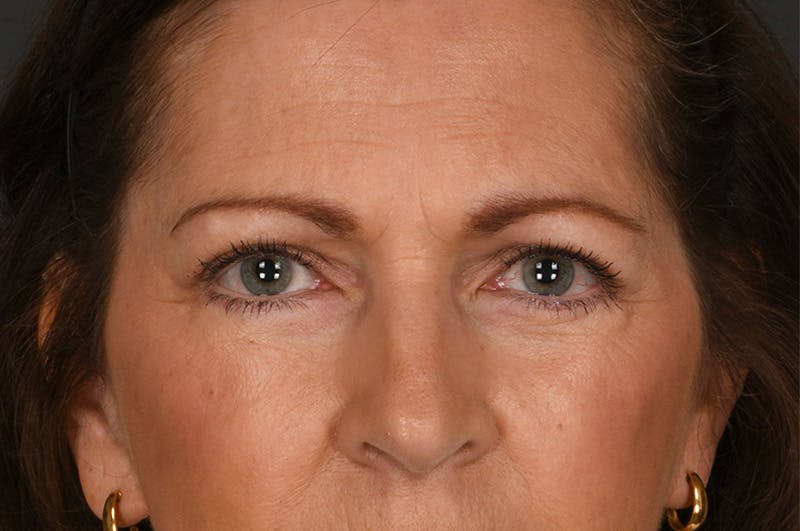 Blepharoplasty Before & After Gallery - Patient 155407963 - Image 2