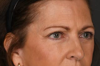 Blepharoplasty Before & After Gallery - Patient 155407963 - Image 4