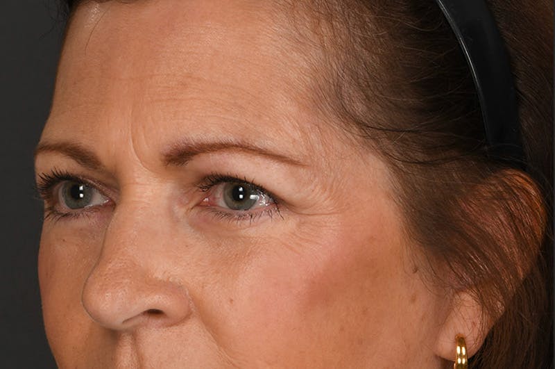 Blepharoplasty Before & After Gallery - Patient 155407963 - Image 8