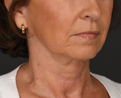 Neck Lift Before & After Gallery - Patient 155407981 - Image 2