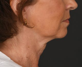 Neck Lift Before & After Gallery - Patient 155407981 - Image 4