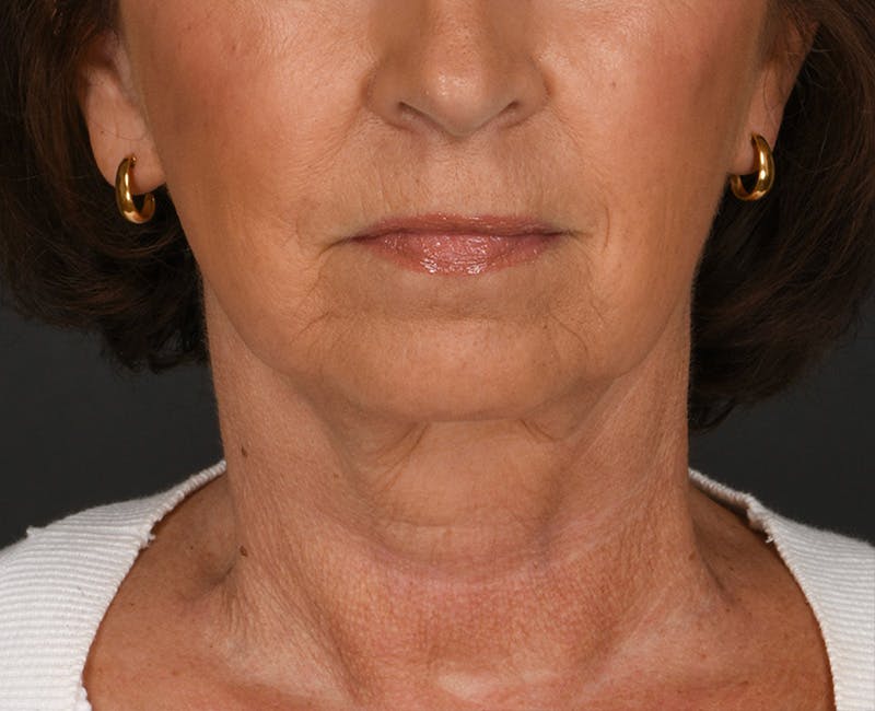 Neck Lift Before & After Gallery - Patient 155407981 - Image 6