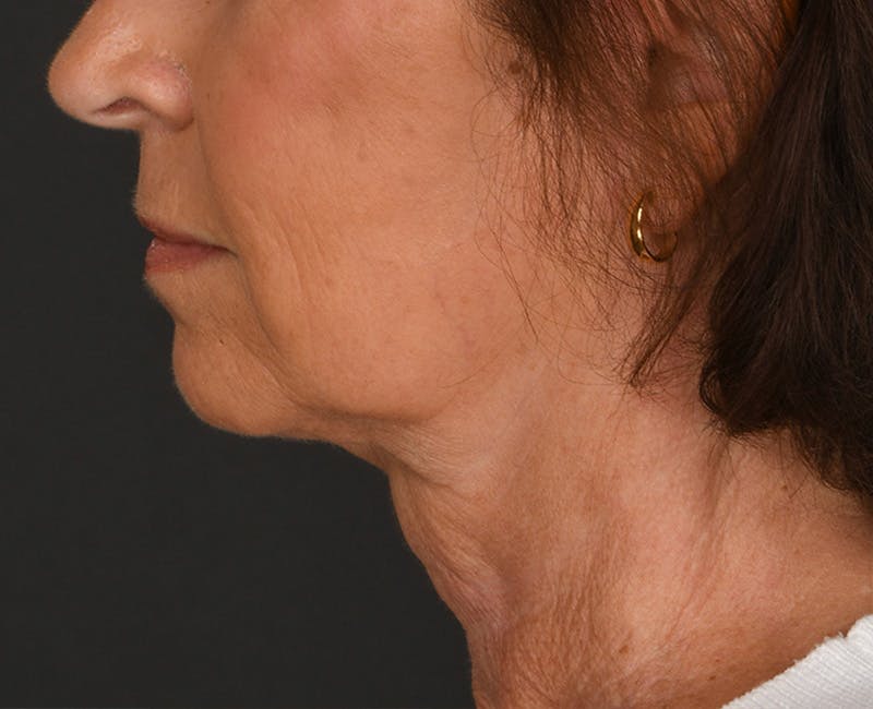 Neck Lift Before & After Gallery - Patient 155407981 - Image 10
