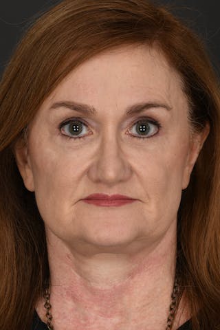 Facelift Before & After Gallery - Patient 256961 - Image 2