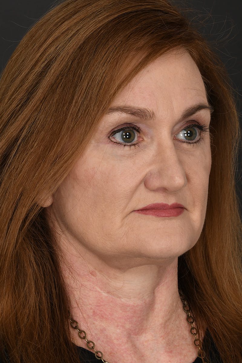 Facelift Before & After Gallery - Patient 256961 - Image 6