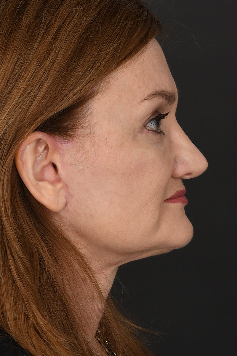 Facelift Before & After Gallery - Patient 256961 - Image 8