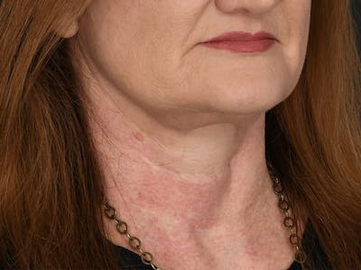 Neck Lift Before & After Gallery - Patient 124262 - Image 2