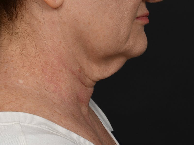 Neck Lift Before & After Gallery - Patient 124262 - Image 5
