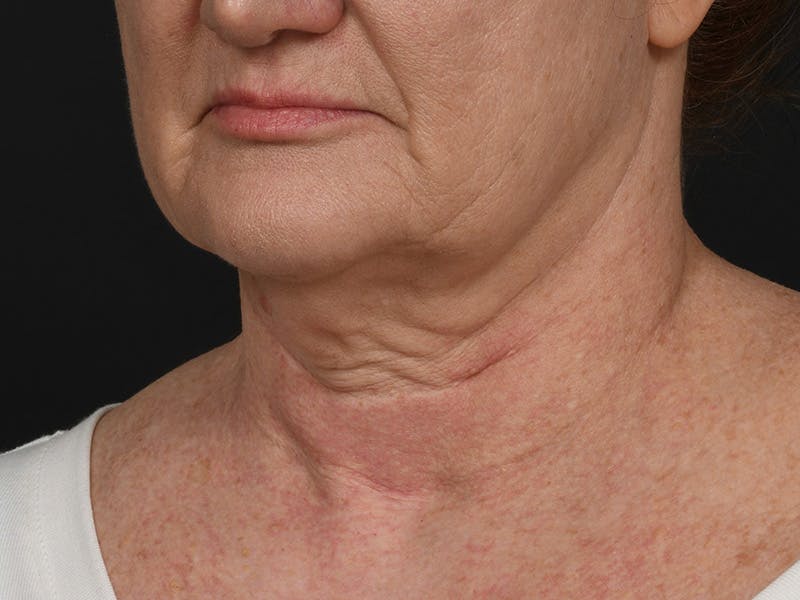 Neck Lift Before & After Gallery - Patient 124262 - Image 9