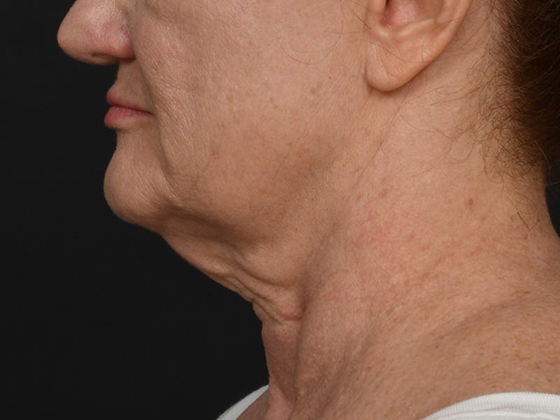 Neck Lift Before & After Gallery - Patient 124262 - Image 11