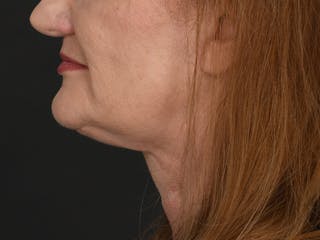 Neck Lift Before & After Gallery - Patient 124262 - Image 12