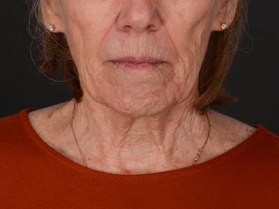 Chin Augmentation Before & After Gallery - Patient 203446 - Image 1